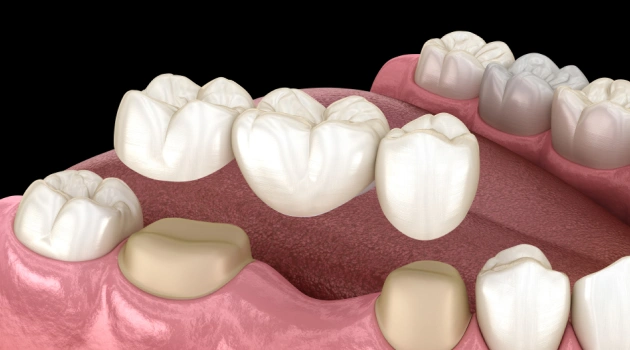 Dental Bridge Eldersburg