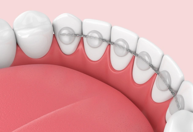 Dental Bonding Eldersburg