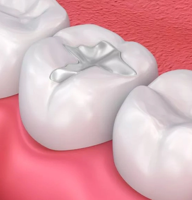 Composite Dental Fillings Eldersburg