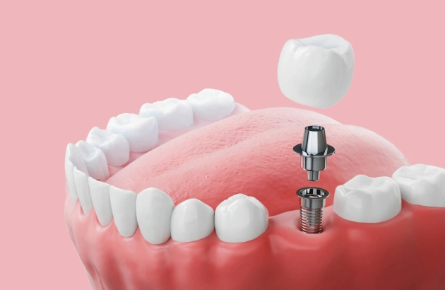 dental implants eldersburg