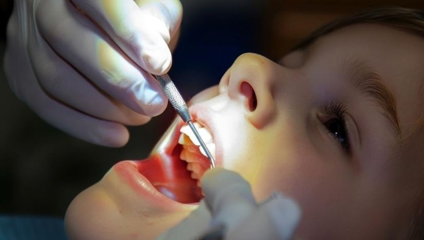 Natural Smile with  Tooth-Colored Fillings 