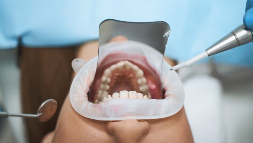 Natural Smile with Tooth-Colored Fillings