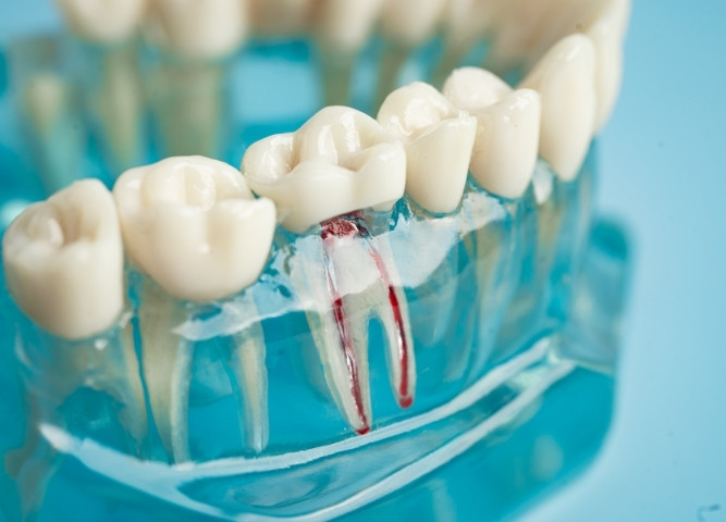 Natural Smile with Tooth-Colored Fillings