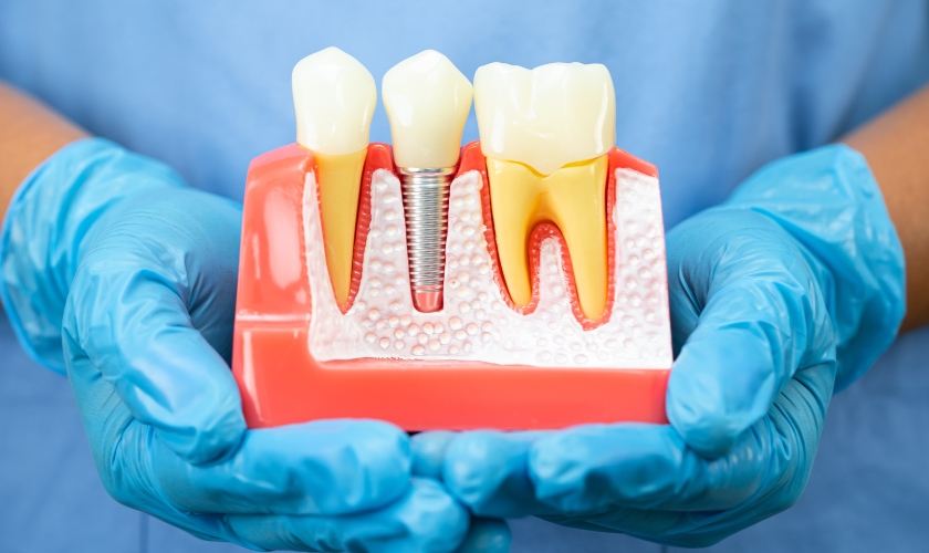 dental implants in Eldersburg