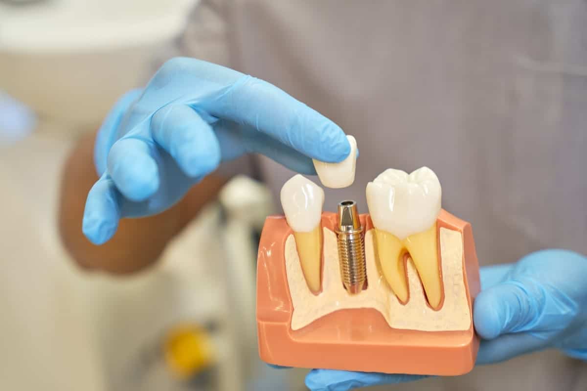 Dental Implants in Sykesville