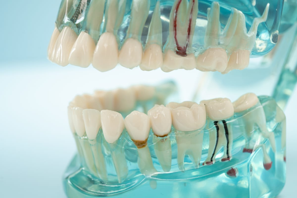 Root Canal Treatment in Eldersburg